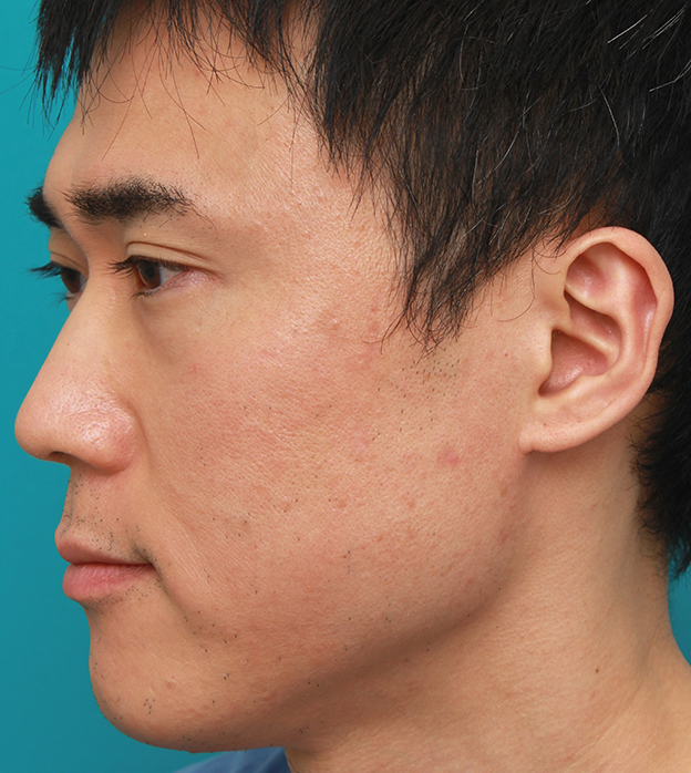 症例写真,顔の盛り上がったシミ（セボケラ、脂漏性角化症）をCO2レーザーアブレージョンで治療した症例写真,2ヶ月後,mainpic_hokuro_ibo_aza06d.jpg