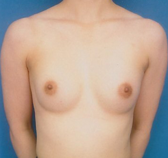 豊胸手術（シリコンプロテーゼ）の症例 大胸筋下に125CCずつ挿入,After,ba_hokyo40_a01.jpg