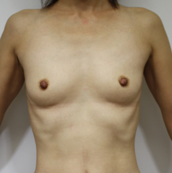 豊胸手術（シリコンプロテーゼ）の症例 大胸筋下に100ccずつ挿入,Before,ba_hokyo17_b.jpg