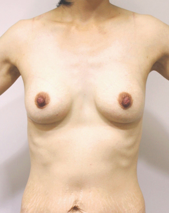 授乳後の萎んで垂れたバストに乳腺下100ccのシリコンプロテーゼで豊胸手術した症例写真,After,ba_hokyo51_a01.jpg