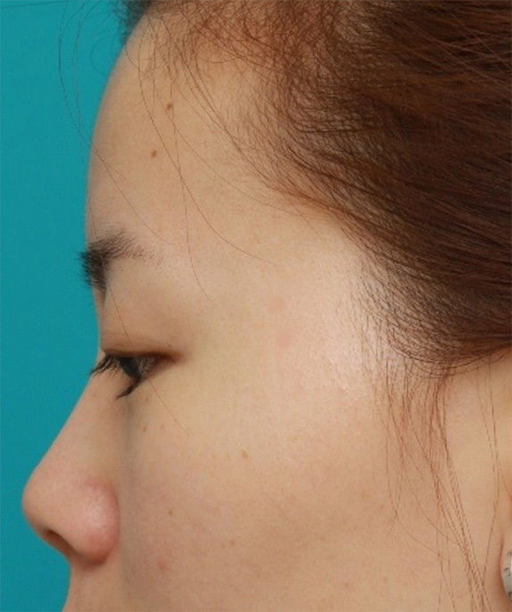 症例写真,顔のホクロをCO2レーザーで除去した症例写真,After（6ヶ月後）,ba_hokuro_ibo_aza24_b.jpg