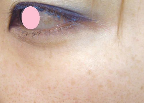 症例写真,フォトフェイシャルM22　毛穴の開きの治療、しみそばかすの治療,Before,ba_iplphoto_pic06_b.jpg
