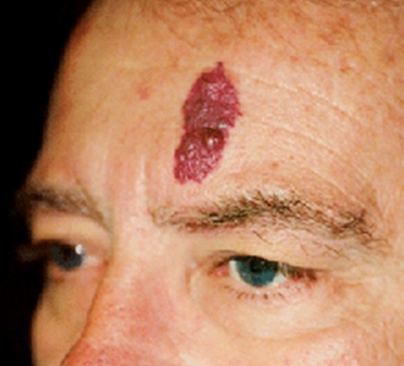 Vビームの症例写真 赤く盛り上がった額の血管腫を治療,Before,ba_vbeam_laser_pic29_b.jpg