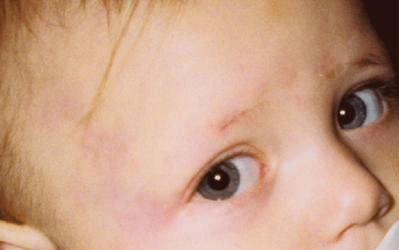 Vビームの症例写真 お子さんの生まれつきの血管腫を治療,After,ba_vbeam_laser_pic28_a01.jpg
