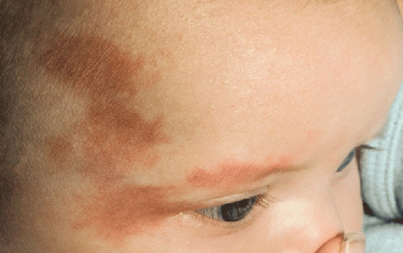 症例写真,Vビームの症例写真 お子さんの生まれつきの血管腫を治療,Before,ba_vbeam_laser_pic28_b.jpg