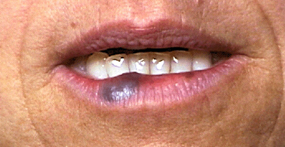 Vビームの症例写真　唇血管腫を治療,Before,ba_vbeam_laser_pic25_b.jpg