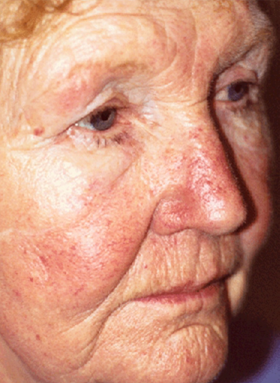 Vビームの症例写真　赤ら顔を治療,After,ba_vbeam_laser_pic26_a01.jpg