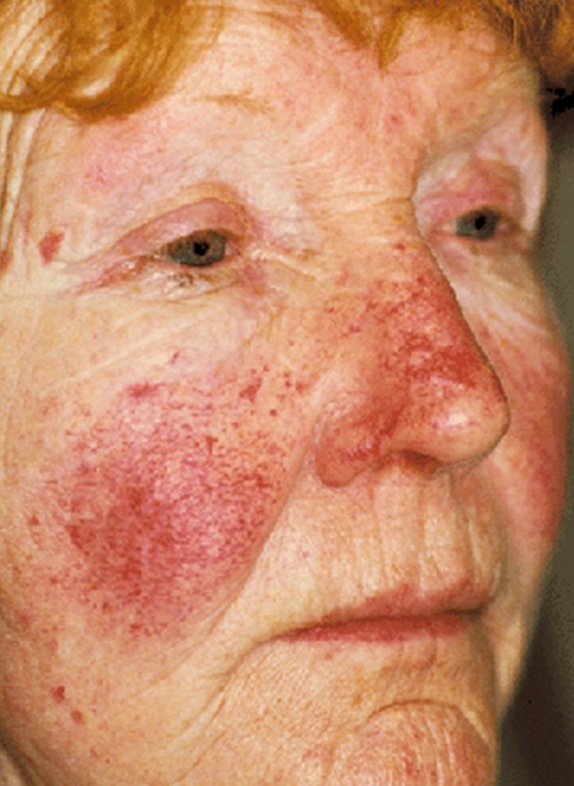 症例写真,Vビームの症例写真　赤ら顔を治療,Before,ba_vbeam_laser_pic26_b.jpg
