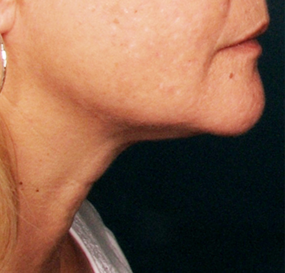 症例写真,ウルセラシステムの症例写真　あごのたるみ,After,ba_ulthera_pic01_b.jpg