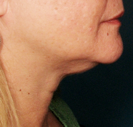 症例写真,ウルセラシステムの症例写真　あごのたるみ,Before,ba_ulthera_pic01_b.jpg