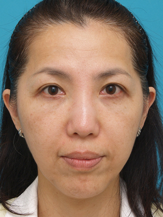 症例写真,ウルセラシステムの症例 頬と首がたるみブルドッグ様の老化が見られた40代女性,After（3ヶ月後）,ba_ulthera_pic06_b.jpg