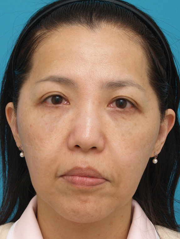 症例写真,ウルセラシステムの症例 頬と首がたるみブルドッグ様の老化が見られた40代女性,Before,ba_ulthera_pic06_b.jpg