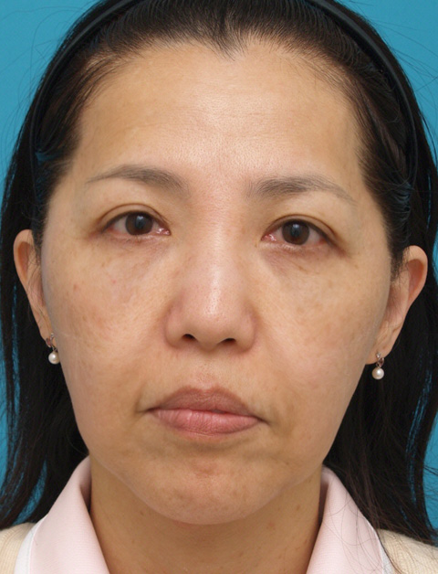 症例写真,ウルセラシステムの症例 頬と首がたるみブルドッグ様の老化が見られた40代女性,施術前,mainpic_ulthera02a.jpg