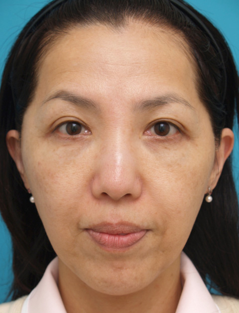 症例写真,ウルセラシステムの症例 頬と首がたるみブルドッグ様の老化が見られた40代女性,施術直後,mainpic_ulthera02b.jpg