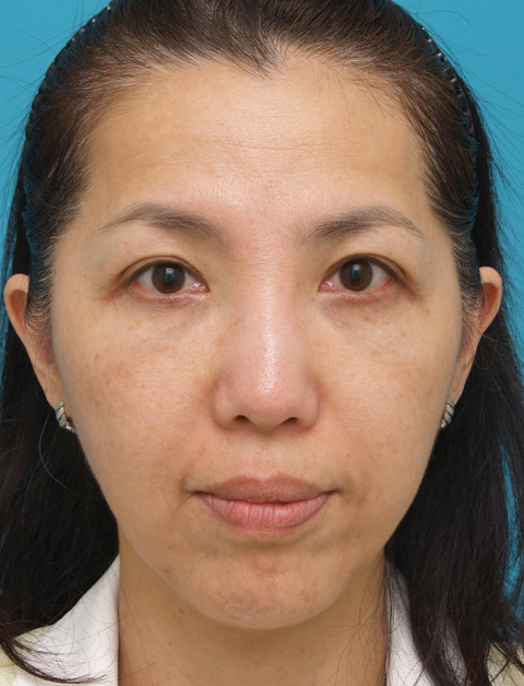 症例写真,ウルセラシステムの症例 頬と首がたるみブルドッグ様の老化が見られた40代女性,3ヶ月後,mainpic_ulthera02c.jpg