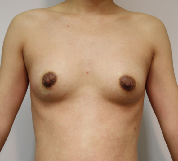 マンマリーヒアル(R)（プチ豊胸術・ヒアルロン酸豊胸術）の症例 胸が垂れていることを気にしていた30代女性,After（1ヶ月後）,ba_mammary_pic30_a01.jpg