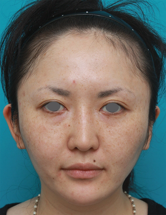 症例写真,20代女性にウルセラシステムを行い、顔が引き締まって小顔になった症例写真,After（2ヶ月後）,ba_ulthera_pic14_b.jpg