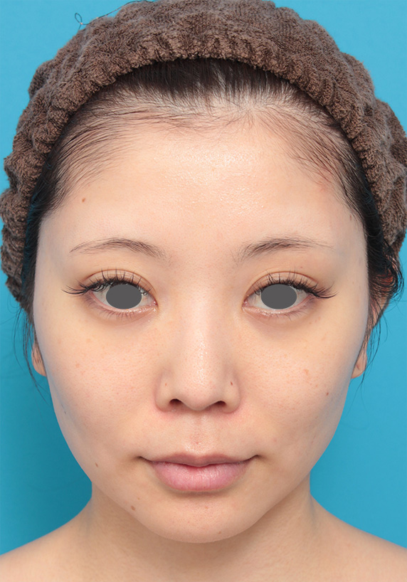 ウルセラシステム,20代女性にウルセラシステムを行い、頬のたるみが引き締まり小顔になった症例写真,After（3ヶ月後）,ba_ulthera15_a01.jpg