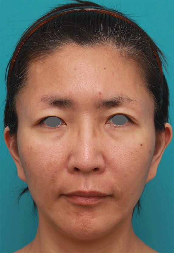 症例写真,イタリアンリフト+ウルセラシステムで切らずに頬のリフトアップした症例写真の術前術後画像,After,ba_ulthera16_b.jpg