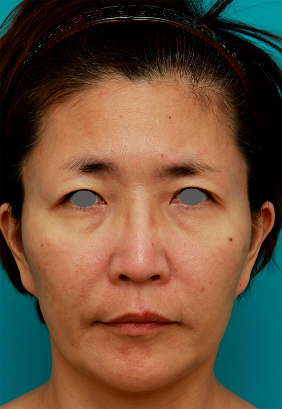 症例写真,イタリアンリフト+ウルセラシステムで切らずに頬のリフトアップした症例写真の術前術後画像,Before,ba_ulthera16_b.jpg
