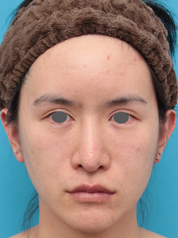 症例写真,20代男性にウルセラシステムを行い、顔のたるみを引き締めた症例写真の術前術後画像,After（3ヶ月後）,ba_ulthera17_b.jpg