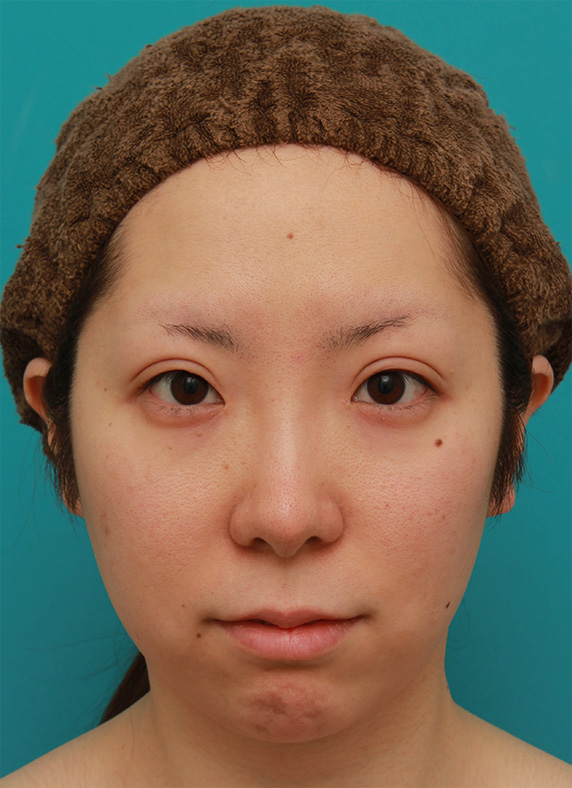 顔の脂肪を注射で溶かした後、ウルセラシステムを行い、頬のたるみを引き締めた20代女性の症例写真,After（3ヶ月後）,ba_ulthera18_a01.jpg