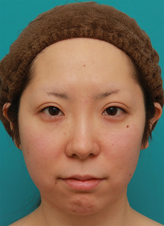 ウルセラシステム,顔の脂肪を注射で溶かした後、ウルセラシステムを行い、頬のたるみを引き締めた20代女性の症例写真,Before,ba_ulthera18_b.jpg