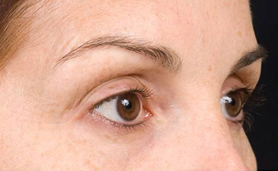 サーマクールアイFLXの症例 まぶたが下がり目が開きにくくなっていた女性,After（15ヶ月後）,ba_thermacool_eye_pic05_a01.jpg