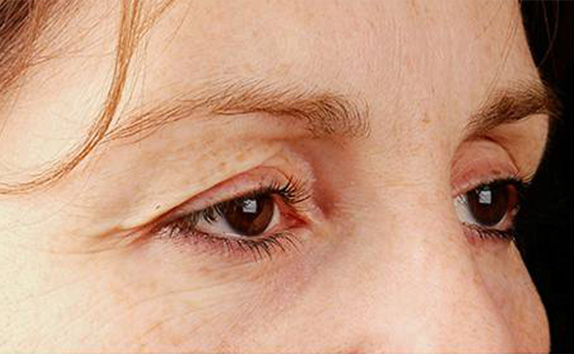 サーマクールアイFLXの症例 まぶたが下がり目が開きにくくなっていた女性,Before,ba_thermacool_eye_pic05_b.jpg