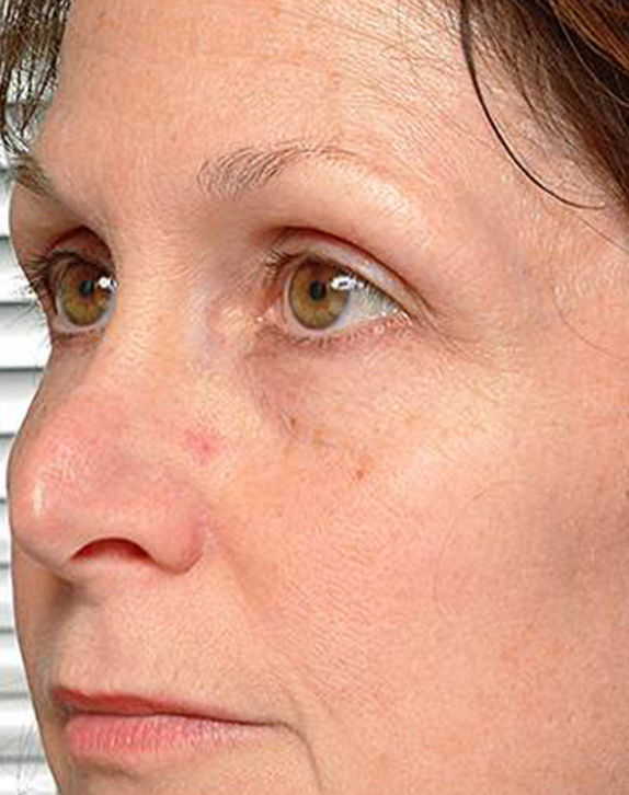 症例写真,サーマクールアイFLXの症例 上まぶたがたるんで下がってきていた女性,After（6ヶ月後）,ba_thermacool_eye_pic01_b.jpg