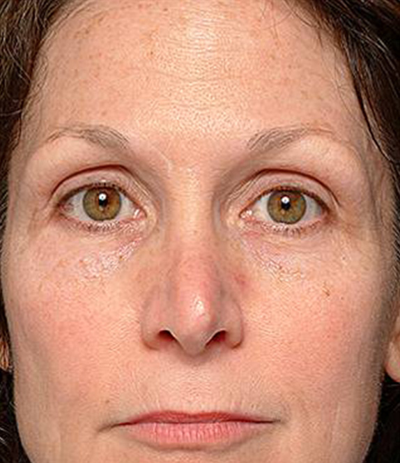 症例写真,サーマクールアイFLXの症例 上まぶたがたるんで下がってきていた女性,After（6ヶ月後）,ba_thermacool_eye_pic02_b.jpg