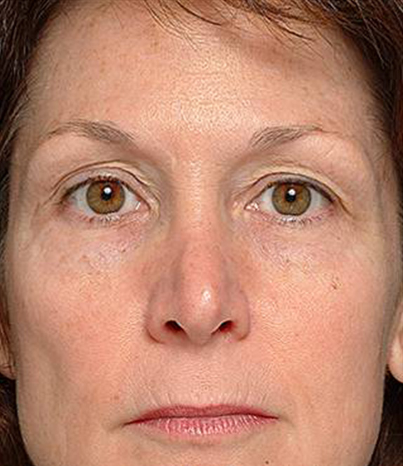 症例写真,サーマクールアイFLXの症例 上まぶたがたるんで下がってきていた女性,Before,ba_thermacool_eye_pic02_b.jpg