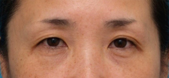 症例写真,サーマクールアイで目の周りの小じわが改善し、わずかに二重の幅が広がり、目が大きくなった症例写真,Before,ba_thermacool_eye06_b.jpg