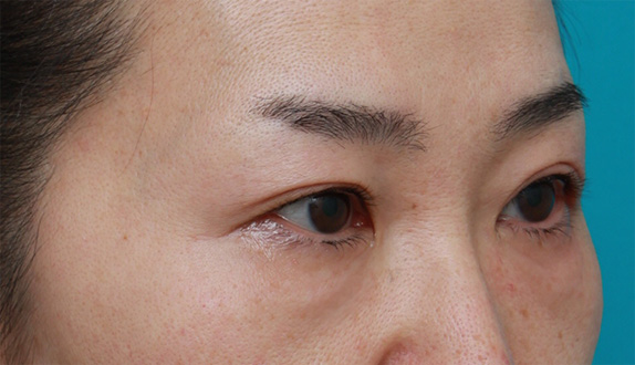 症例写真,サーマクールアイで目の開きが良くなった症例写真の術前術後画像の解説,After（2ヶ月後）,ba_thermacool_eye08_b.jpg