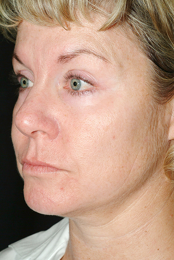サーマクールFLXの症例 顔にたるみが生じていた女性,After,ba_thermacool_pic08_a01.jpg