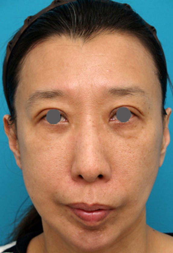 サーマクールFLXの症例 肌にハリがなくなり口角も下がっていた女性,After,ba_thermacool_pic25_a01.jpg