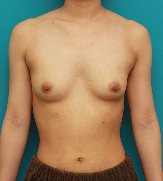胸がほぼ平らに近い女性に、ヒアルロン酸を50ccずつ注入し、ほどよい自然な膨らみを作った症例の術前術後画像,Before,ba_mammary57_b.jpg
