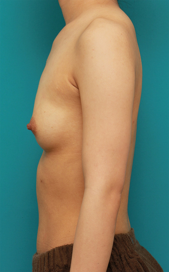 症例写真,胸がほぼ平らに近い女性に、ヒアルロン酸を50ccずつ注入し、ほどよい自然な膨らみを作った症例写真の術前術後画像,Before,ba_mammary61_b.jpg