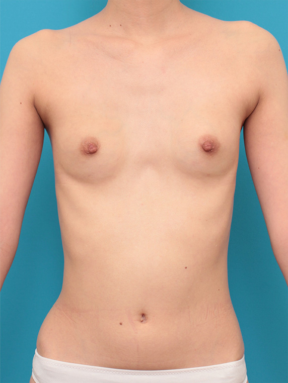 症例写真,漏斗胸もあって非常に痩せている女性の胸にヒアルロン酸を40ccずつ注射し、バストに膨らみを出した症例写真の術前術後画像,After（1週間後）,ba_mammary68_b.jpg