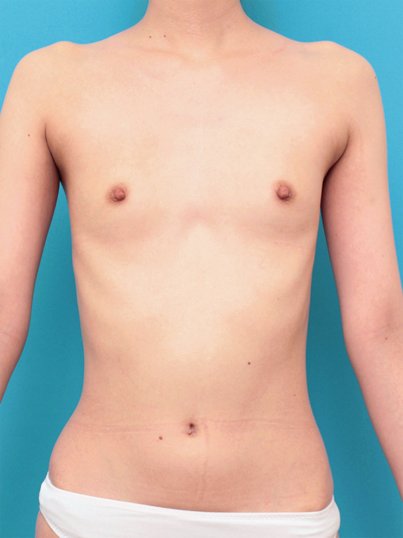 症例写真,漏斗胸もあって非常に痩せている女性の胸にヒアルロン酸を40ccずつ注射し、バストに膨らみを出した症例の術前術後画像,Before,ba_mammary68_b.jpg