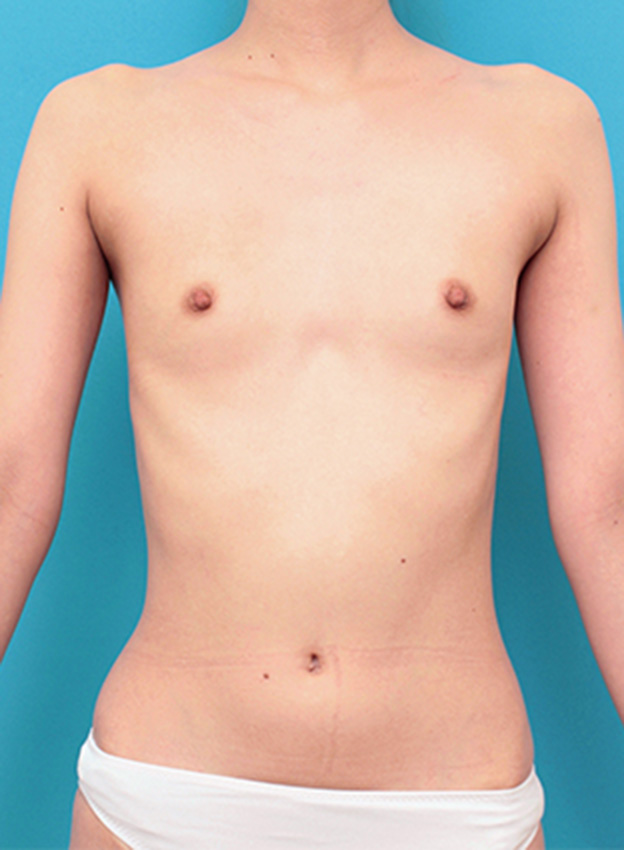 症例写真,漏斗胸もあって非常に痩せている女性の胸にヒアルロン酸を40ccずつ注射し、バストに膨らみを出した症例写真の術前術後画像,注射前,mainpic_mammary06a.jpg