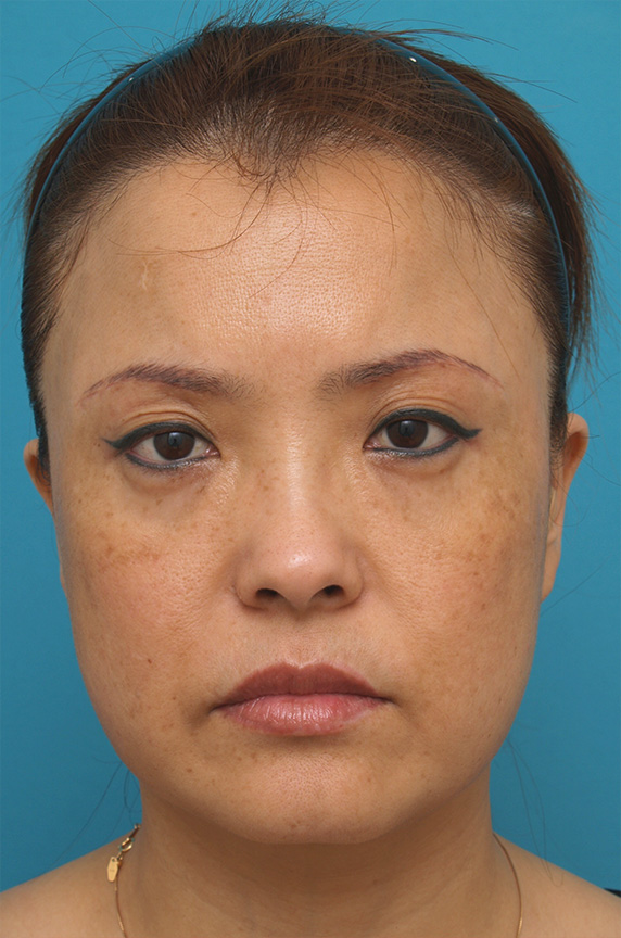 サーマクール,40代女性に行ったサーマクール症例写真,Before,ba_thermacool_pic27_b.jpg