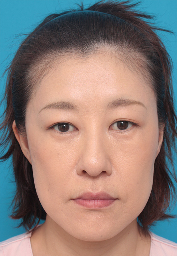 サーマクール,40代女性の顔と首にサーマクールを照射した症例写真,Before,ba_thermacool_pic29_b.jpg