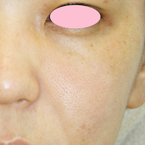 症例写真,フォトRF　顔全体の治療,Before,ba_rf_05_b.jpg