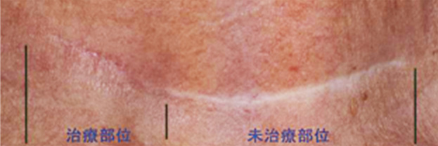 フラクセル2の症例写真　首の傷跡に4回照射,After,ba_flaxel_pic09_a01.jpg