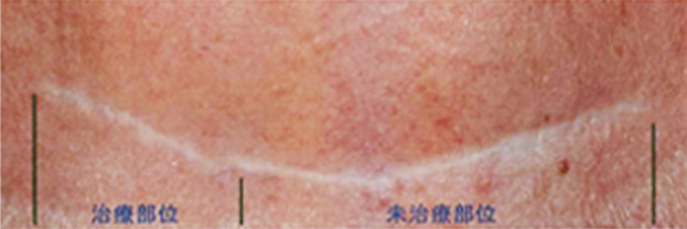フラクセル2の症例写真　首の傷跡に4回照射,Before,ba_flaxel_pic09_b.jpg