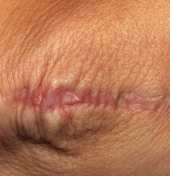 フラクセル2の症例写真　膝の傷跡の治療,Before,ba_flaxel_pic22_b.jpg