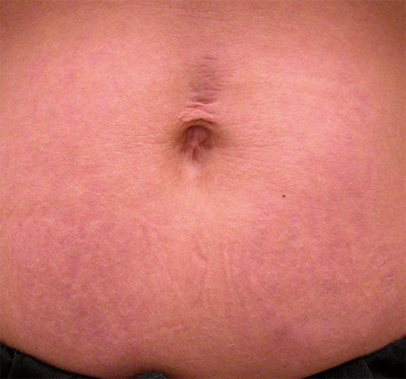 フラクセル2の症例写真　妊娠線の治療,After,ba_flaxel_pic20_a01.jpg