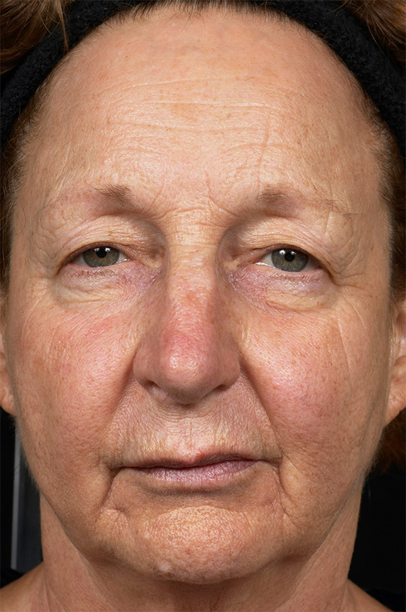 症例写真,フラクセル2　顔全体の小じわの治療,After（1ヶ月後）,ba_flaxel_pic15_b.jpg