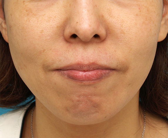 顎の梅干しジワに注射式シワ取り ボツリヌストキシン注射した症例写真,Before,ba_botox_pic14_b.jpg